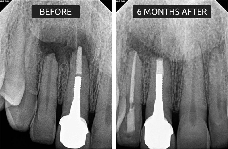 Before and After - Endodontics - Prestige Dental Specialists | Annandale VA