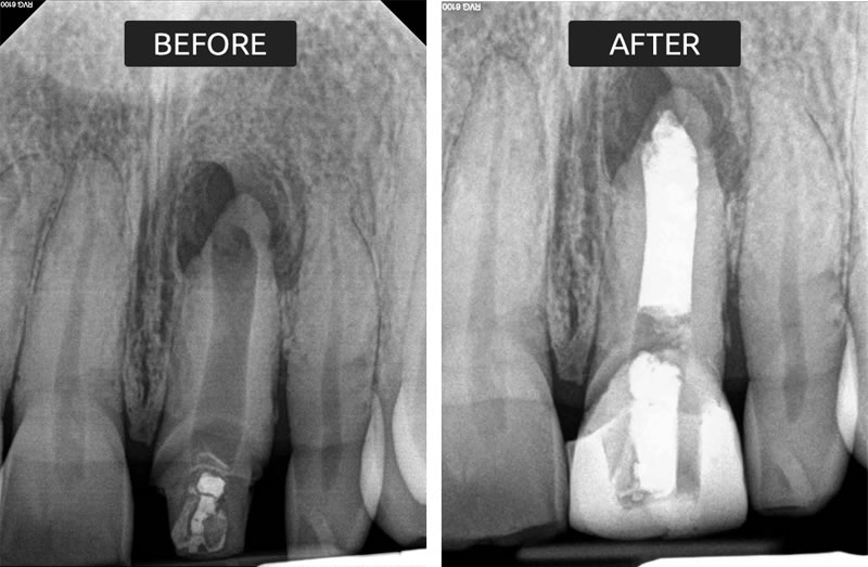 Before and After - Endodontics - Prestige Dental Specialists | Annandale VA