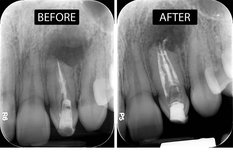 front tooth root canal